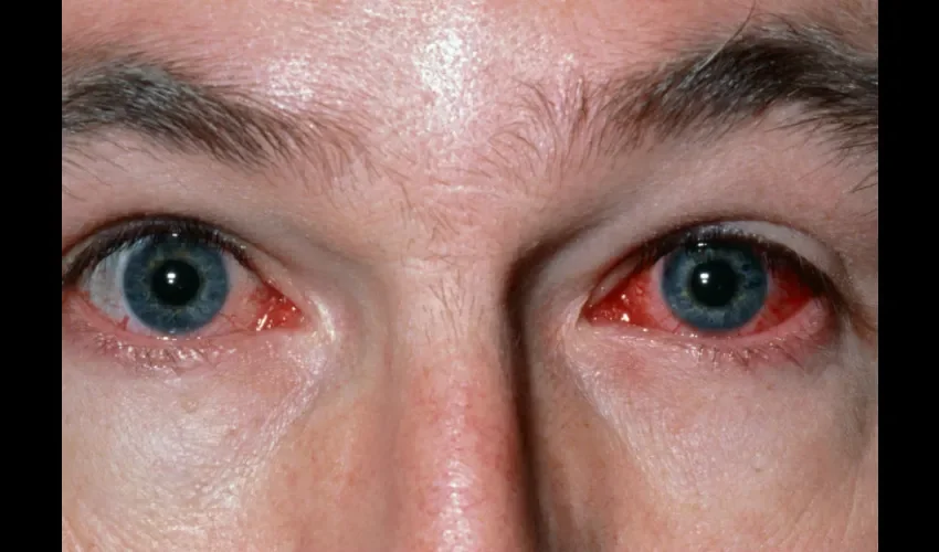 Foto ilustrativa de  una persona con conjuntivitis. 