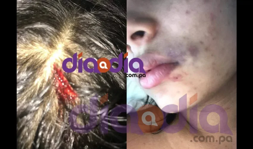 Sucede que anoche se filtraron varias imágenes en las que se puede ver a la chica con moretones en su cara, un golpe horrible en su muslo, en los brazos, en la boca... 