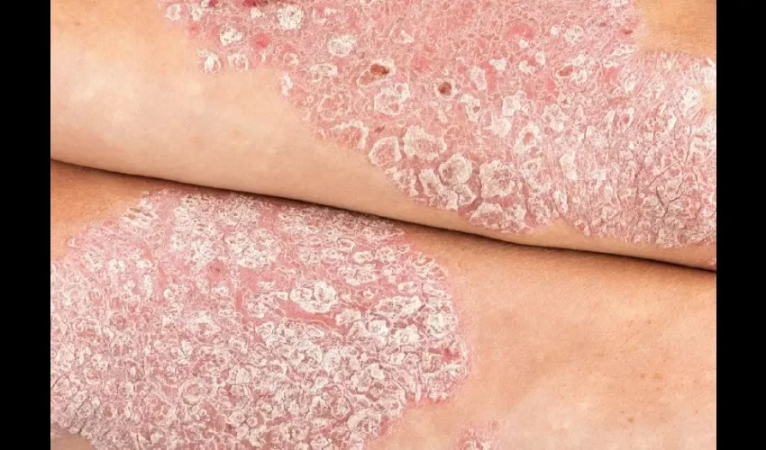 Foto ilustrativa de la psoriasis. 